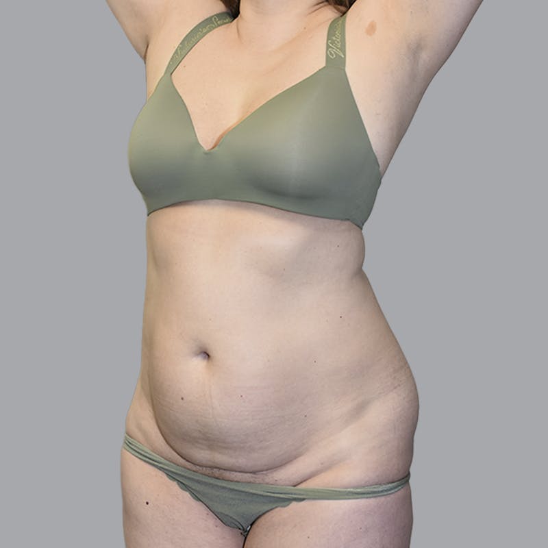Abdominoplasty Before & After Gallery - Patient 474408 - Image 5