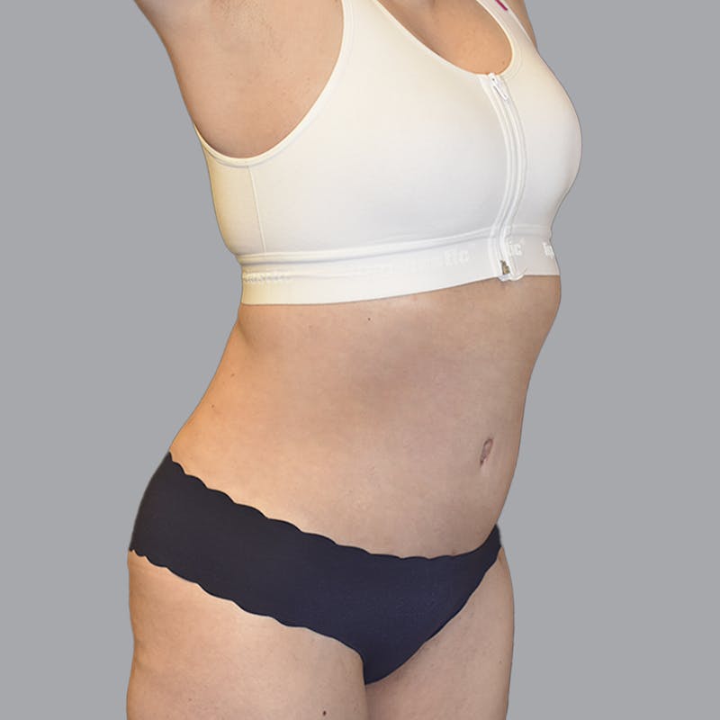 Abdominoplasty Before & After Gallery - Patient 474408 - Image 4