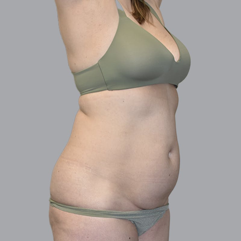 Abdominoplasty Before & After Gallery - Patient 474408 - Image 3