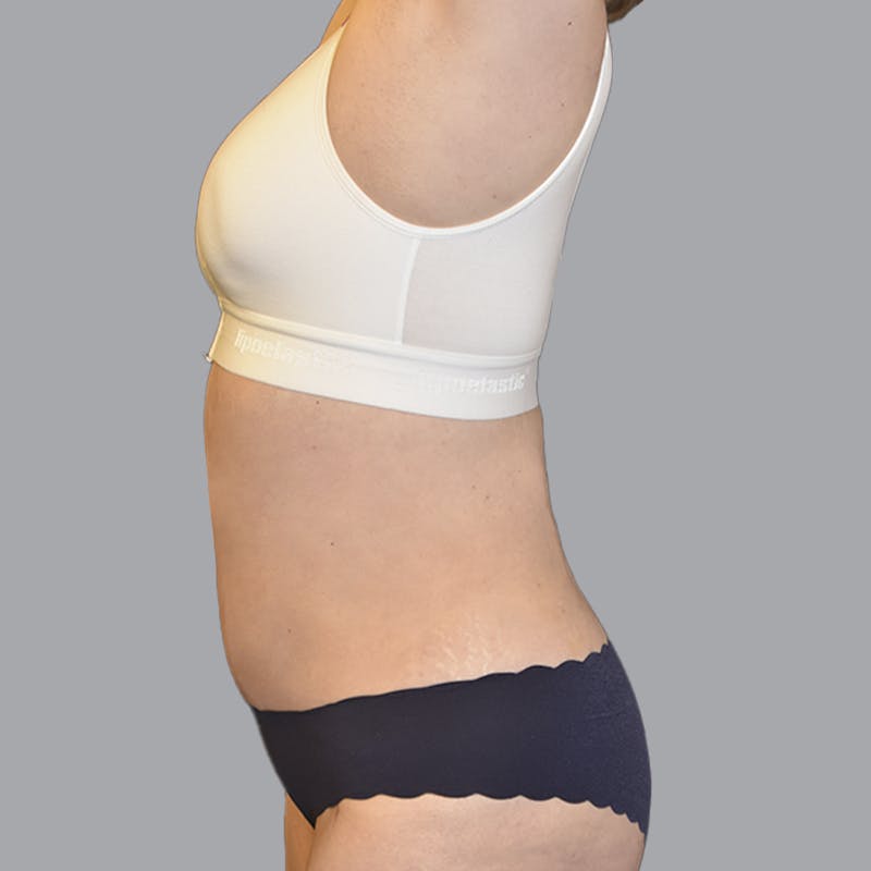 Abdominoplasty Before & After Gallery - Patient 474408 - Image 8