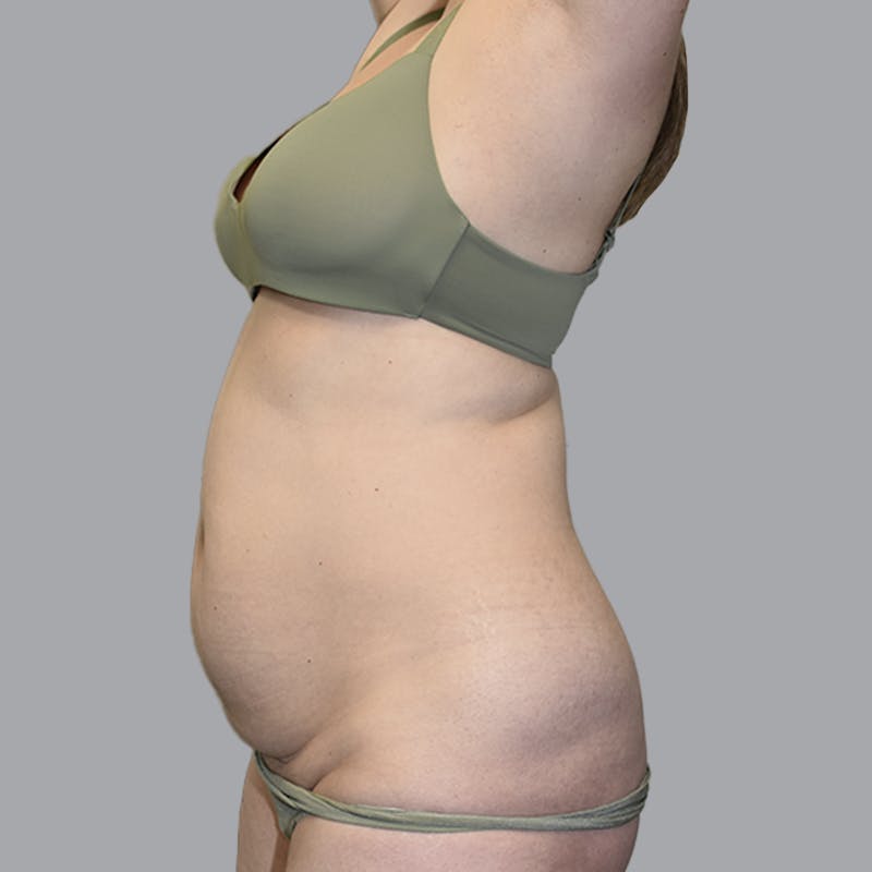 Abdominoplasty Before & After Gallery - Patient 474408 - Image 7