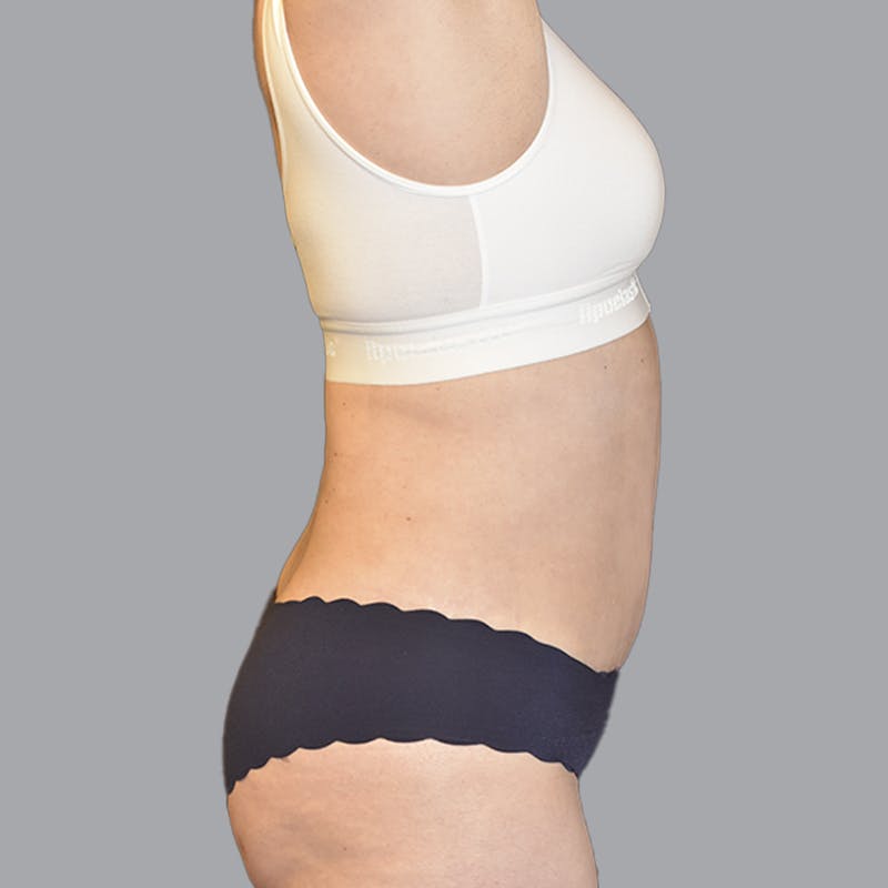 Abdominoplasty Before & After Gallery - Patient 474408 - Image 10