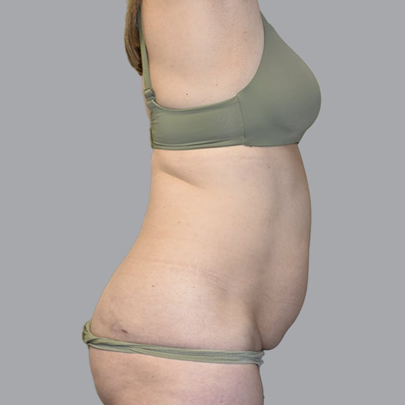 Abdominoplasty Before & After Gallery - Patient 474408 - Image 9