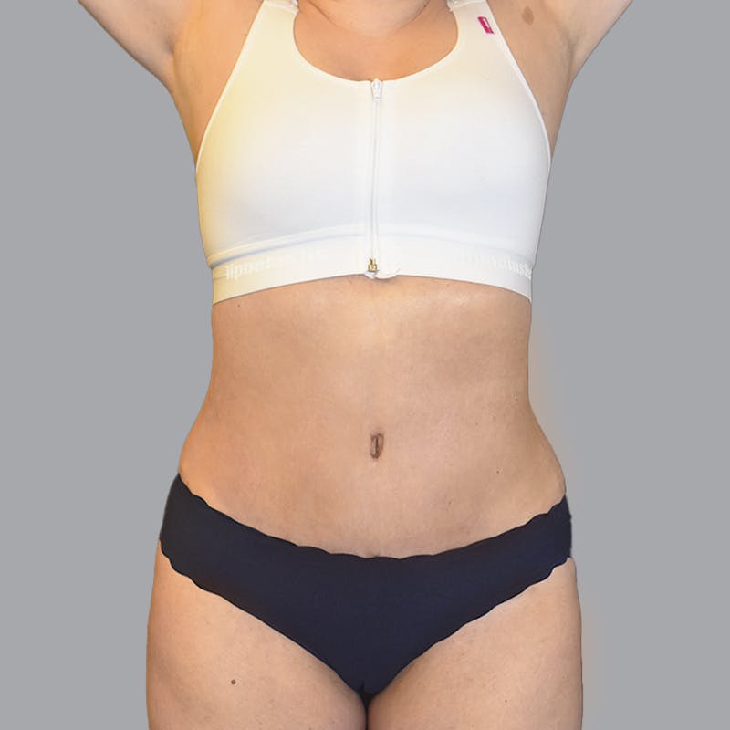 Abdominoplasty Before & After Gallery - Patient 474408 - Image 2