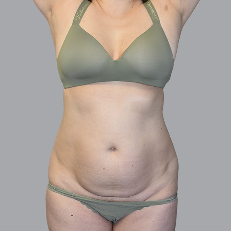 Abdominoplasty Before & After Gallery - Patient 474408 - Image 1