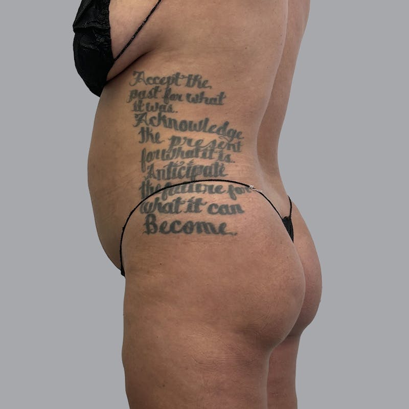 Brazilian Butt Lift and Hip Dip Before & After Gallery - Patient 178904 - Image 3