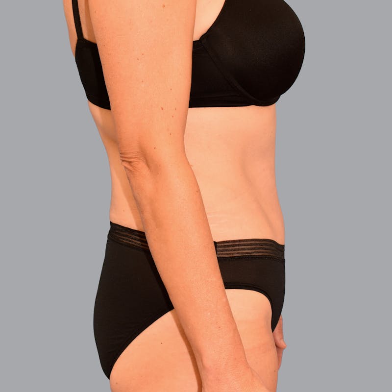 Abdominoplasty Before & After Gallery - Patient 371509 - Image 6