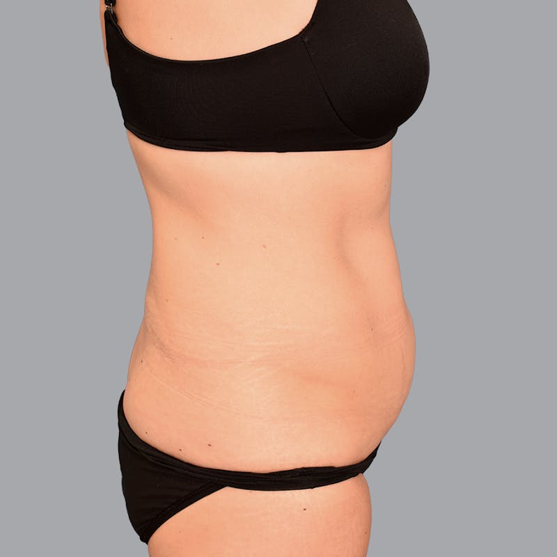 Abdominoplasty Before & After Gallery - Patient 371509 - Image 5