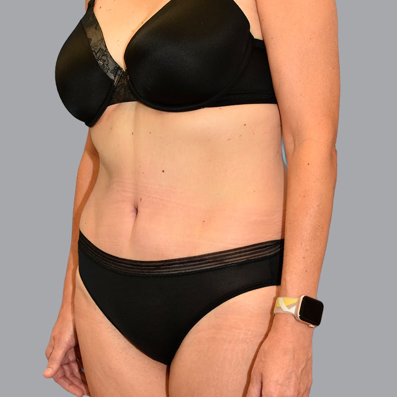 Abdominoplasty Before & After Gallery - Patient 371509 - Image 4