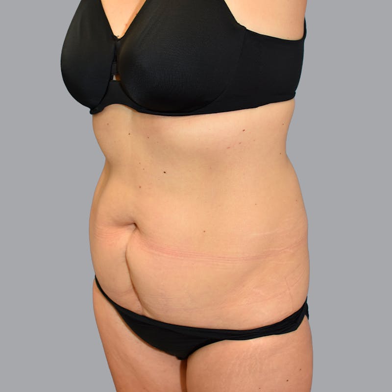 Abdominoplasty Before & After Gallery - Patient 371509 - Image 3