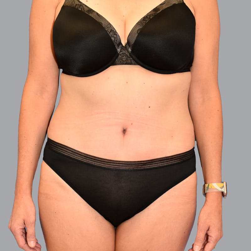 Abdominoplasty Before & After Gallery - Patient 371509 - Image 2