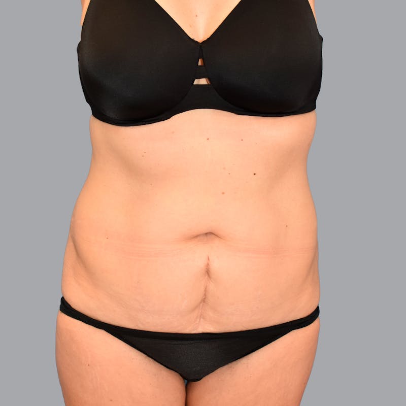 Abdominoplasty Before & After Gallery - Patient 371509 - Image 1
