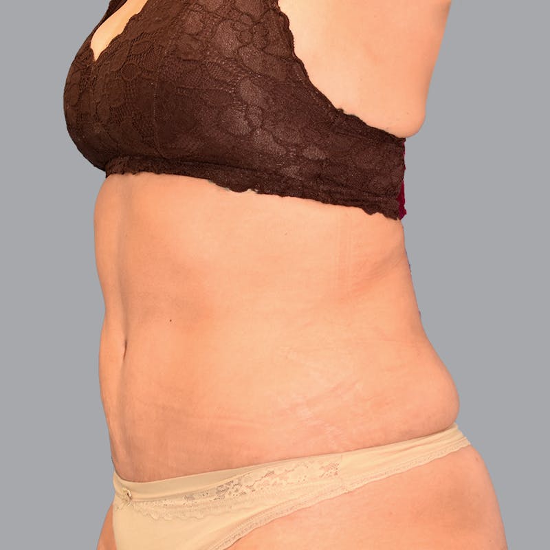 Abdominoplasty Before & After Gallery - Patient 345064 - Image 4
