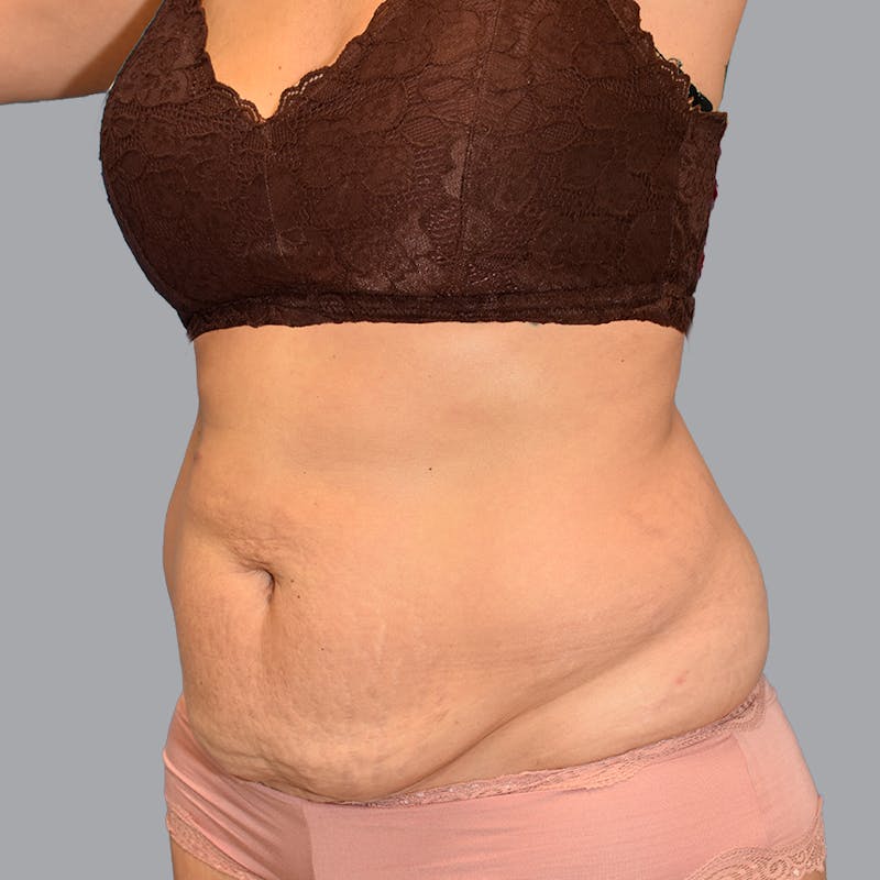 Abdominoplasty Before & After Gallery - Patient 345064 - Image 3
