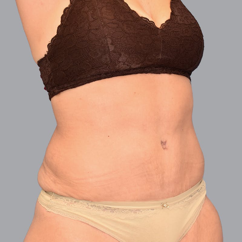 Abdominoplasty Before & After Gallery - Patient 345064 - Image 6