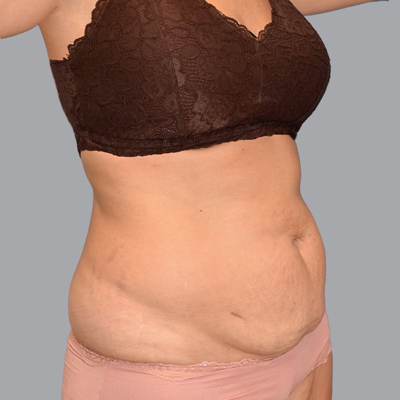 Abdominoplasty Before & After Gallery - Patient 345064 - Image 5