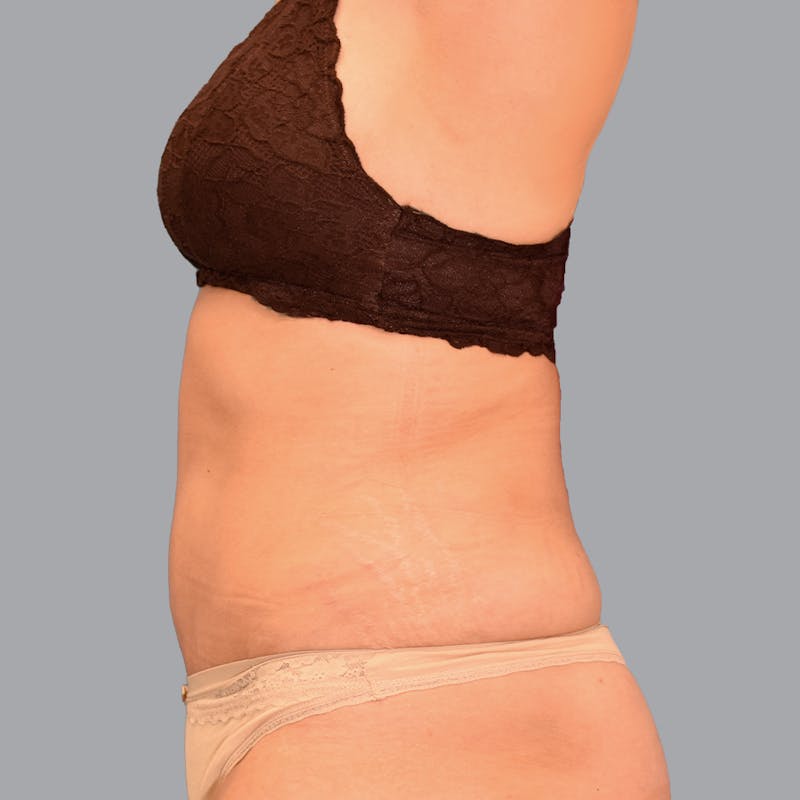 Abdominoplasty Before & After Gallery - Patient 345064 - Image 8