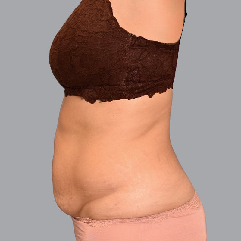 Abdominoplasty Before & After Gallery - Patient 345064 - Image 7