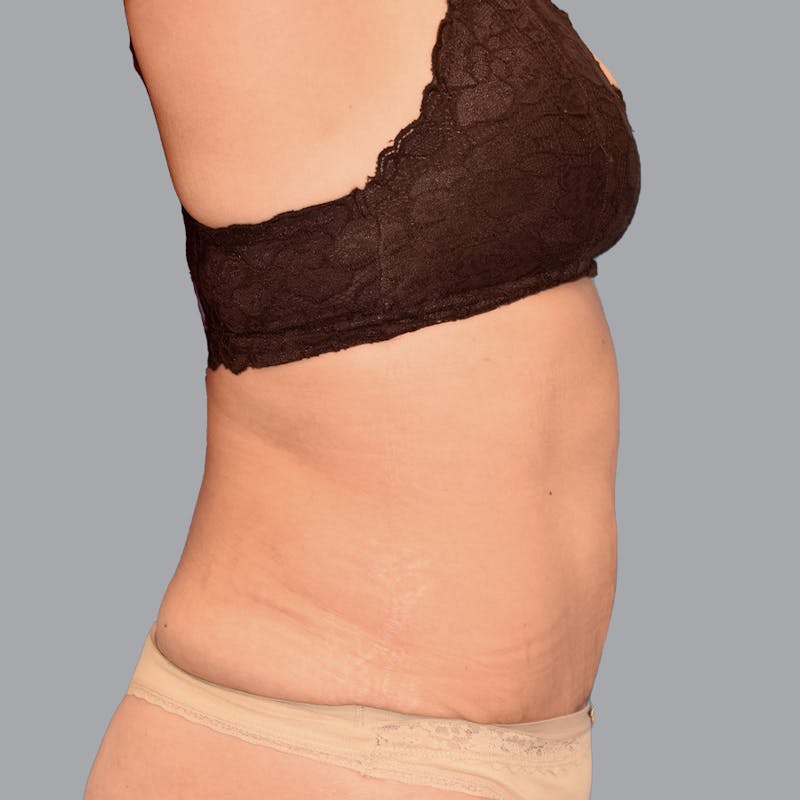 Abdominoplasty Before & After Gallery - Patient 345064 - Image 10