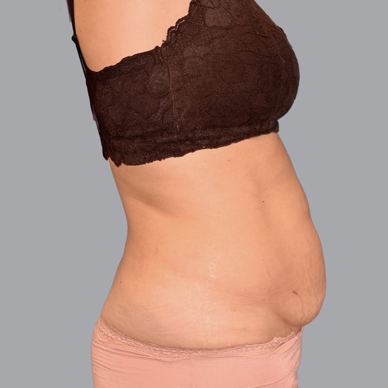 Abdominoplasty Before & After Gallery - Patient 345064 - Image 9