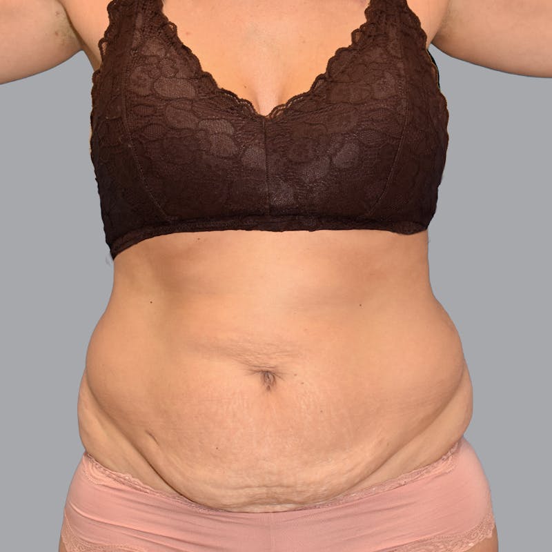 Abdominoplasty Before & After Gallery - Patient 345064 - Image 1