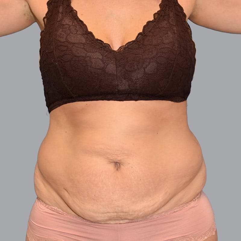 Abdominoplasty Before & After Gallery - Patient 345064 - Image 1
