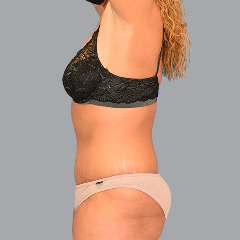 Abdominoplasty Before & After Gallery - Patient 696350 - Image 8