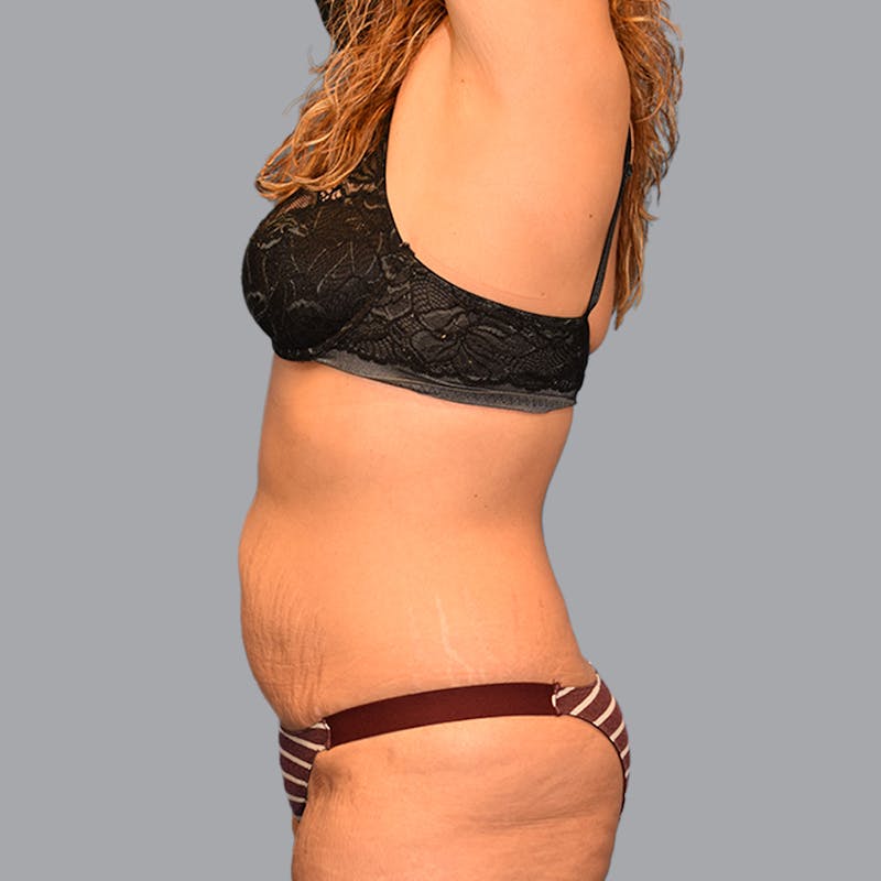 Abdominoplasty Before & After Gallery - Patient 696350 - Image 7