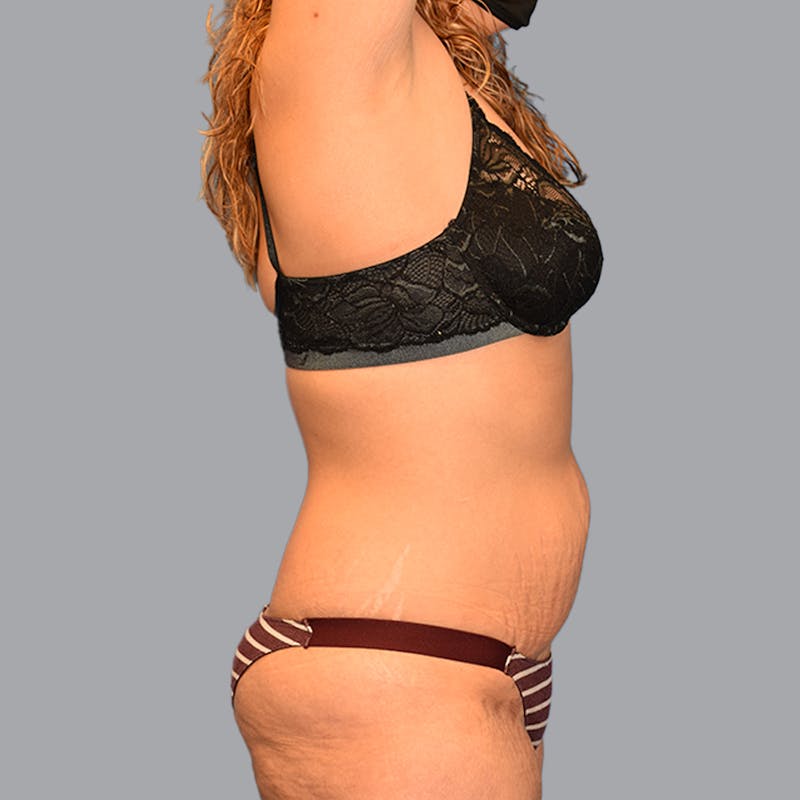 Abdominoplasty Before & After Gallery - Patient 696350 - Image 9