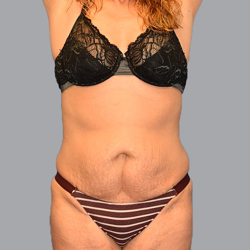 Abdominoplasty Before & After Gallery - Patient 696350 - Image 1