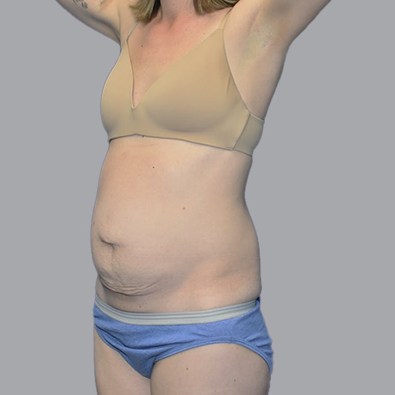 Abdominoplasty Before & After Gallery - Patient 215124 - Image 3