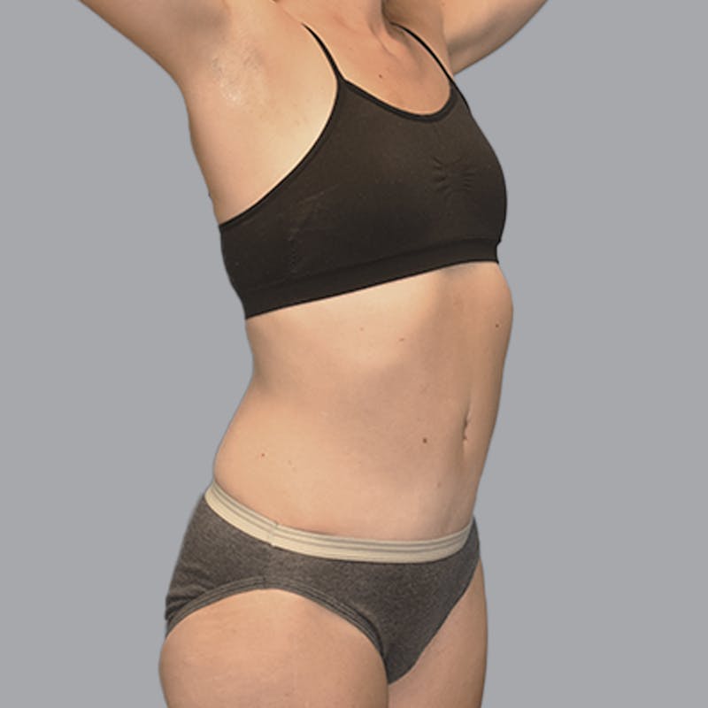 Abdominoplasty Before & After Gallery - Patient 215124 - Image 6