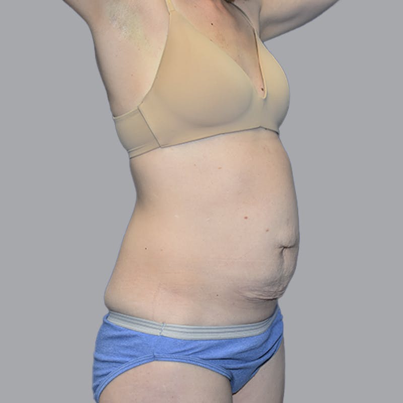 Abdominoplasty Before & After Gallery - Patient 215124 - Image 5