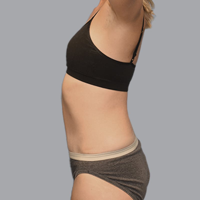 Abdominoplasty Before & After Gallery - Patient 215124 - Image 8
