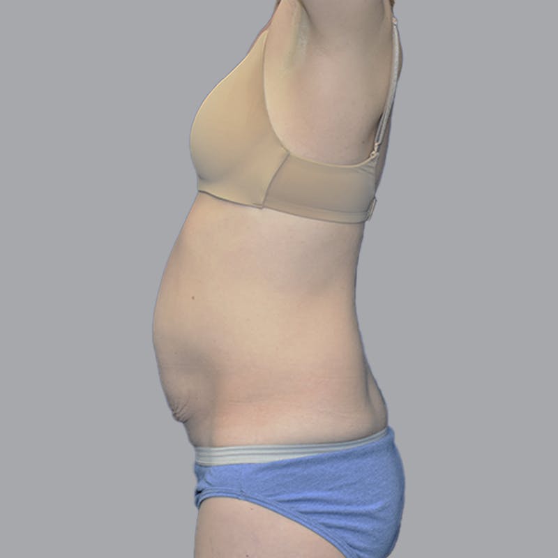 Abdominoplasty Before & After Gallery - Patient 215124 - Image 7