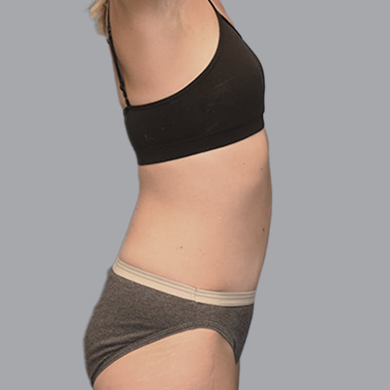 Abdominoplasty Before & After Gallery - Patient 215124 - Image 10