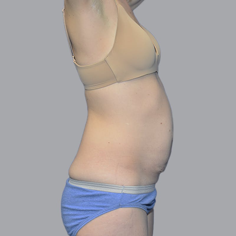 Abdominoplasty Before & After Gallery - Patient 215124 - Image 9