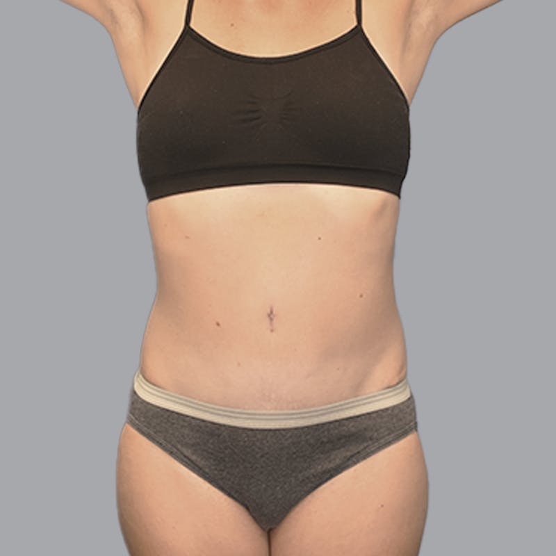 Abdominoplasty Before & After Gallery - Patient 215124 - Image 2