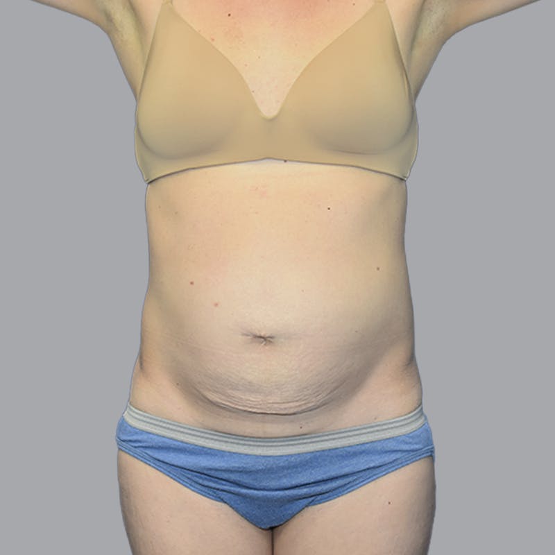 Abdominoplasty Before & After Gallery - Patient 215124 - Image 1