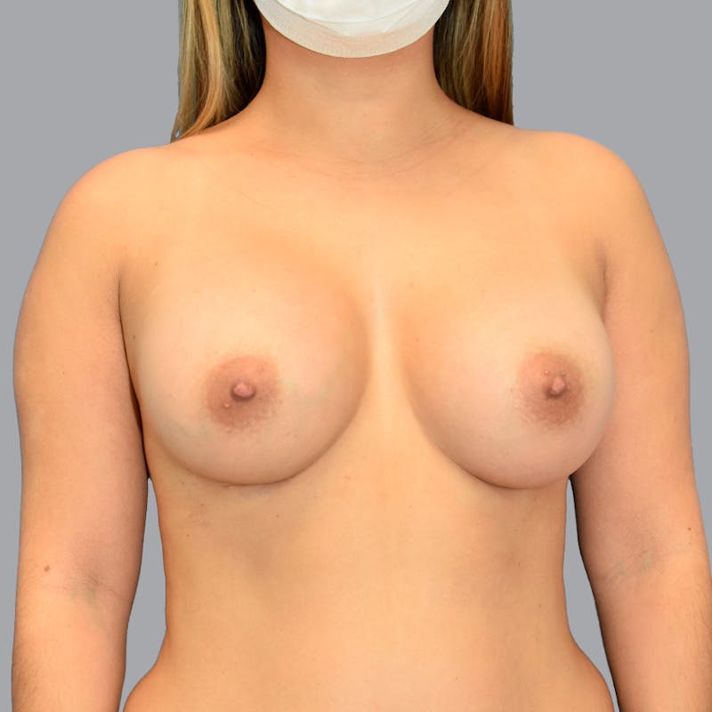 Breast Augmentation Before & After Gallery - Patient 699279 - Image 2