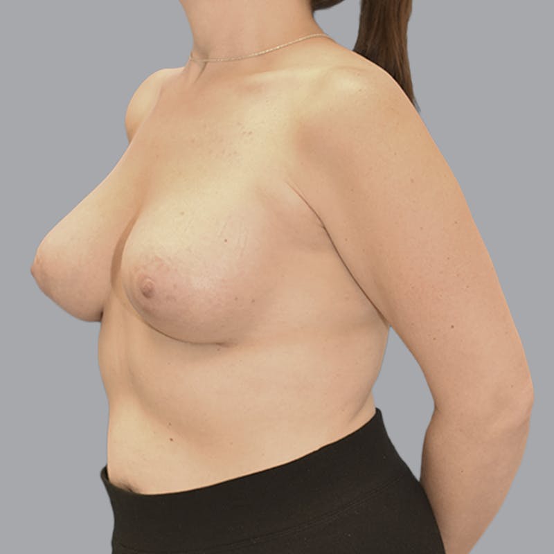 Breast Augmentation Before & After Gallery - Patient 215847 - Image 6