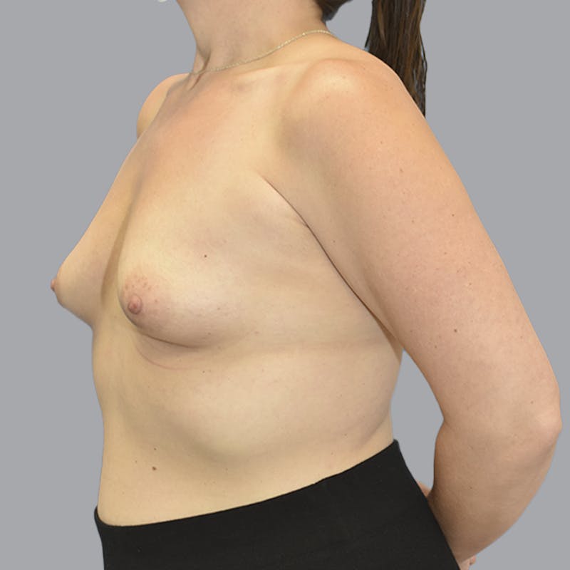 Breast Augmentation Before & After Gallery - Patient 215847 - Image 5