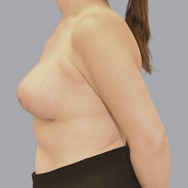 Breast Augmentation Before & After Gallery - Patient 215847 - Image 8