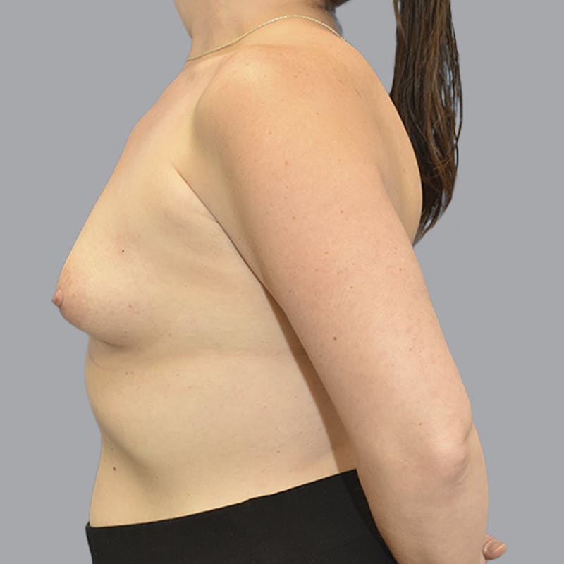 Breast Augmentation Before & After Gallery - Patient 215847 - Image 7