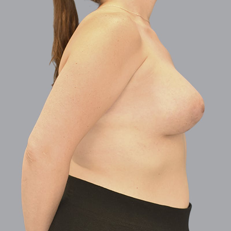 Breast Augmentation Before & After Gallery - Patient 215847 - Image 10