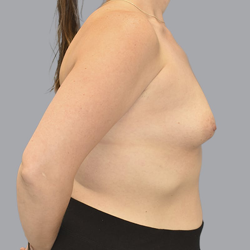 Breast Augmentation Before & After Gallery - Patient 215847 - Image 9