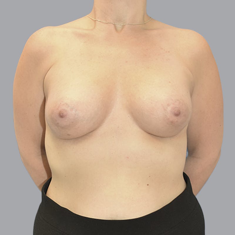 Breast Augmentation Before & After Gallery - Patient 215847 - Image 2