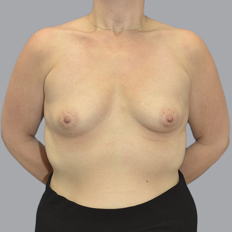 Breast Augmentation Before & After Gallery - Patient 215847 - Image 1