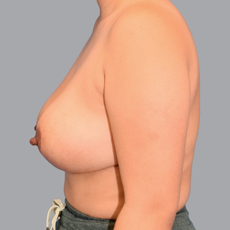Breast Lift Before & After Gallery - Patient 168049 - Image 8