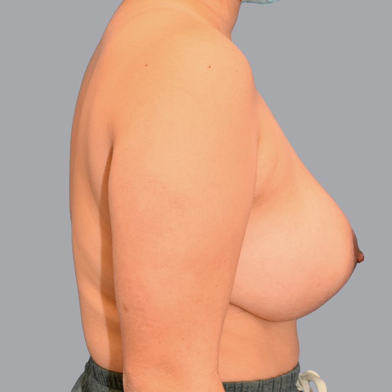 Breast Lift Before & After Gallery - Patient 168049 - Image 10